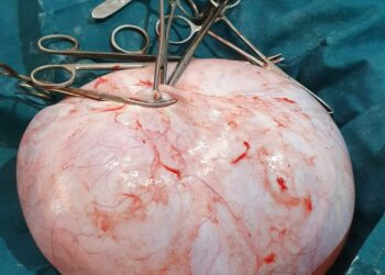 কাটোয়ার চিকিৎসকের  সফল অস্ত্রপচার,রোগিনীর পেট থেকে বেরলো ১০ কেজি টিউমার