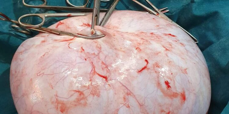 কাটোয়ার চিকিৎসকের  সফল অস্ত্রপচার,রোগিনীর পেট থেকে বেরলো ১০ কেজি টিউমার