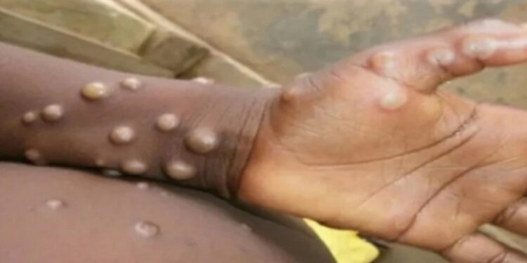 দীর্ঘ ১৮ বছর পর ফের বিশ্বের সামনে এল বিরল ‘মাঙ্কিপক্স’ সংক্রমনের ঘটনা