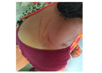 বিজেপি করায় দম্পতিকে মারধর করে পুড়িয়ে মারার চেষ্টার অভিযোগ