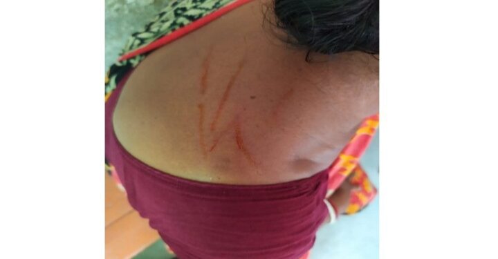 বিজেপি করায় দম্পতিকে মারধর করে পুড়িয়ে মারার চেষ্টার অভিযোগ