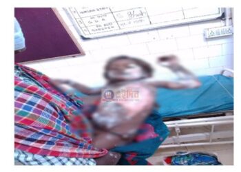 সকালে আগুন পোহানোর সময় আঁচে পড়ে দগ্ধ কাটোয়ার ইঁট ভাটার শিশু