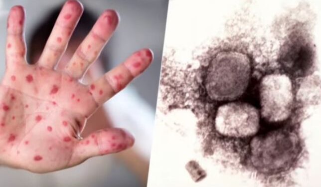 বিশ্বের ১১ টি দেশে ৮০ জনের শরীরে মাঙ্কি পক্সের লক্ষ্মণ পাওয়া গেছে বলে জানালো ডবলুএইচও