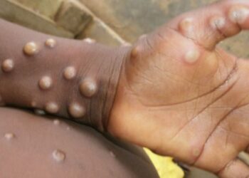 মাঙ্কিপক্স নিয়ন্ত্রণযোগ্য, কোভিডের মত সংক্রামক নয় : বিশ্ব স্বাস্থ্য সংস্থা