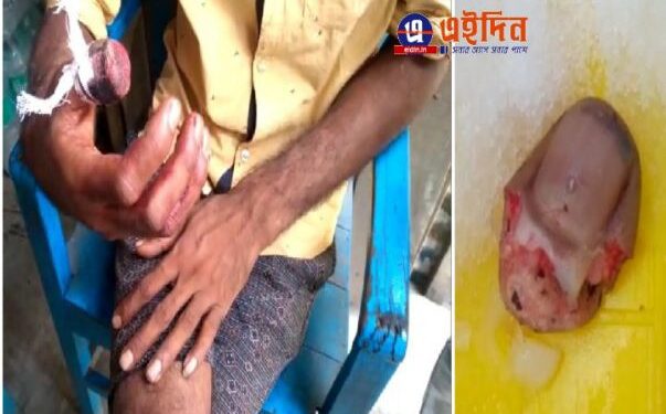 সাপ নয়, ঝাপানতলায় এক মনসা ভক্তের ডান হাতের বুড়ো আঙুল কামড়ে কেটে বিচ্ছিন্ন করে দিল মদ্যপ ব্যক্তি