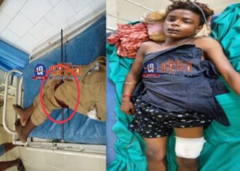 কাটোয়া হাসপাতালে জটিল অস্ত্রপচার করে কিশোরের পায়ে গেঁথে যাওয়া রড বের করলেন চিকিৎসক