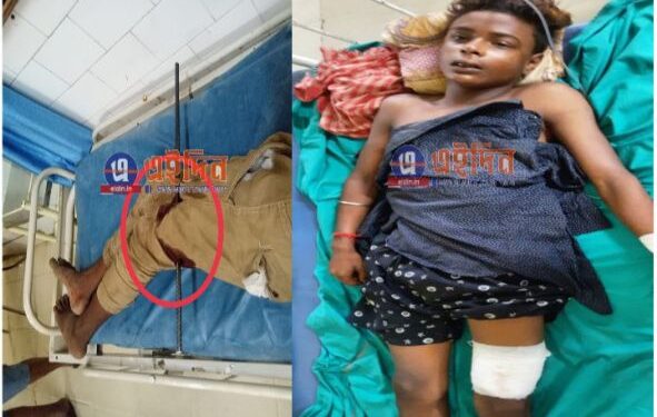 কাটোয়া হাসপাতালে জটিল অস্ত্রপচার করে কিশোরের পায়ে গেঁথে যাওয়া রড বের করলেন চিকিৎসক