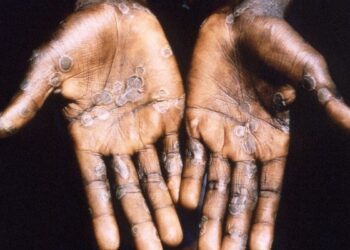 কেরালার পর এবার দিল্লিতে মাঙ্কিপক্সের হানা, দেশজুড়ে মোট রোগী ৪