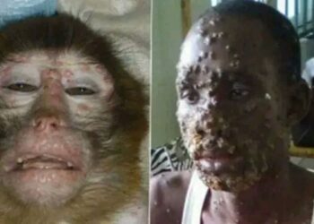 মাঙ্কিপক্সের কারনে দেশ জুড়ে স্বাস্থ্য জরুরি অবস্থা ঘোষণা করল আমেরিকা