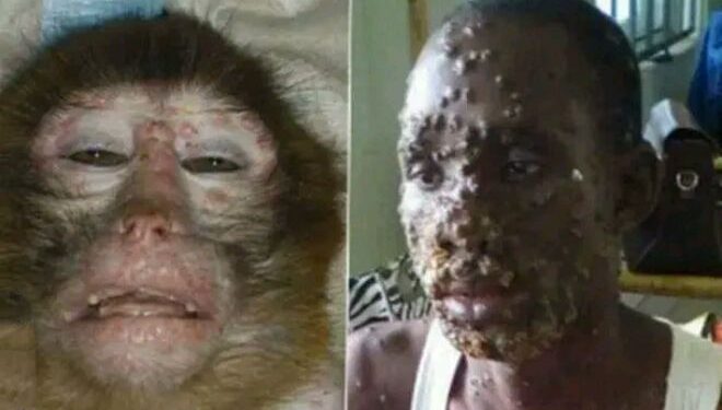 মাঙ্কিপক্সের কারনে দেশ জুড়ে স্বাস্থ্য জরুরি অবস্থা ঘোষণা করল আমেরিকা