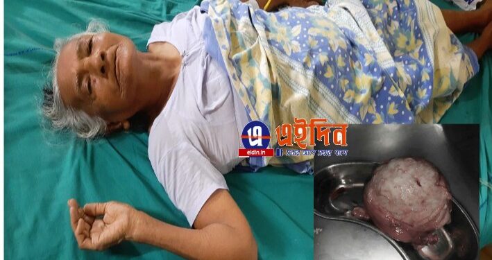 ৮২ বছরের বৃদ্ধার জরায়ুতে ২ কেজি ওজনের টিউমার, অস্ত্রোপচার করে বের করলেন কাটোয়া হাসপাতালের চিকিৎসক