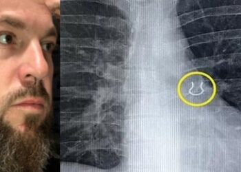 পাঁচ বছর আগে হারিয়ে যাওয়া নথ উদ্ধার হল যুবকের ফুসফুস থেকে