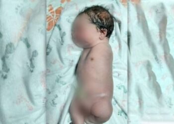 আফগানিস্তানে দু’হাত ছাড়াই শিশুর জন্ম
