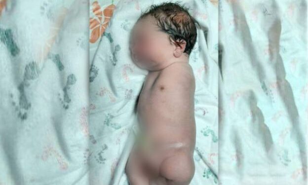 আফগানিস্তানে দু’হাত ছাড়াই শিশুর জন্ম