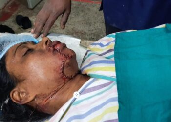 জটিল অস্ত্রপচার করে দূর্ঘটনায় কেটে ঝুলে যাওয়া বধূর থুতনি জোড়া লাগালেন কাটোয়া হাসপাতালের চিকিৎসকরা
