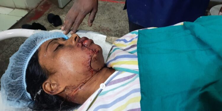 জটিল অস্ত্রপচার করে দূর্ঘটনায় কেটে ঝুলে যাওয়া বধূর থুতনি জোড়া লাগালেন কাটোয়া হাসপাতালের চিকিৎসকরা