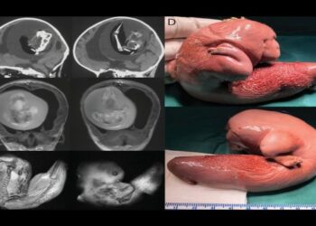 এক বছরের শিশুর মস্তিষ্কে যমজ ভ্রুণ