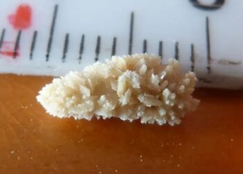 শ্রীলঙ্কার ব্যক্তির শরীর থেকে বের হল পাঁচটি বেসবলের সমান ওজন বিশিষ্ট কিডনি স্টোন