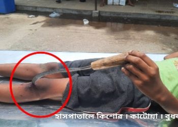 কিশোরের পায়ে গেঁথে যাওয়া কাস্তে অস্ত্রোপচার করে বের করল কাটোয়া হাসপাতালের চিকিৎসকরা