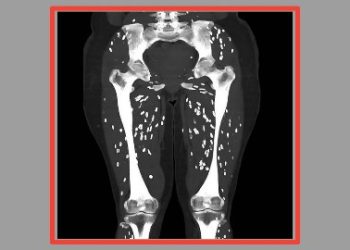 ভালোভাবে রান্না না করে শুয়োরের মাংস খেয়ে পরজীবী দ্বারা গুরুতর সংক্রমিত মার্কিন ব্যক্তি