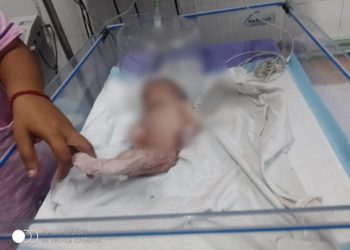 কাটোয়া হাসপাতালে ‘মৎসকন্যা শিশুর’ জন্ম, তোলপাড় এলাকায়