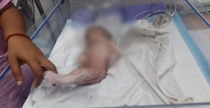 কাটোয়া হাসপাতালে ‘মৎসকন্যা শিশুর’ জন্ম, তোলপাড় এলাকায়