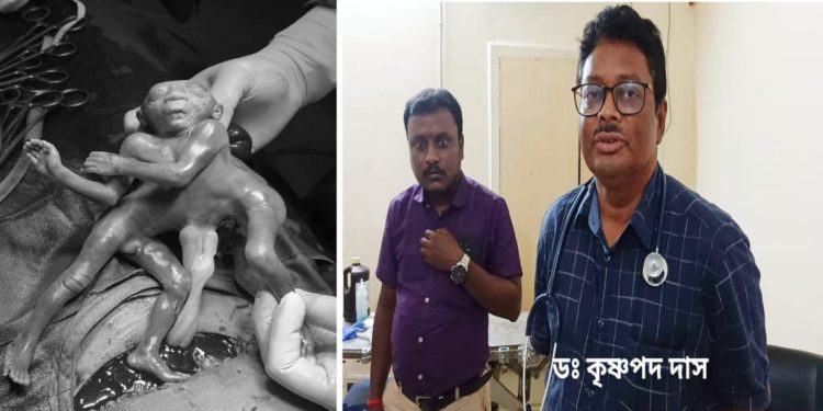 এক মাথা-চার হাত ও চার পা বিশিষ্ট অদ্ভুতদর্শন শিশুর জন্ম ভাতারের বেসরকারি হাসপাতালে