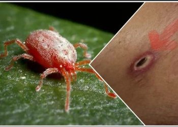 স্ক্রাব টাইফাস : একটি প্রাণঘাতী সংক্রমণ ; এই সংক্রমণের উপসর্গ,প্রতিকার ও সতর্কতা অবলম্বনের বিষয়ে বিশেষজ্ঞরা কি পরামর্শ দিচ্ছেন জানুন  