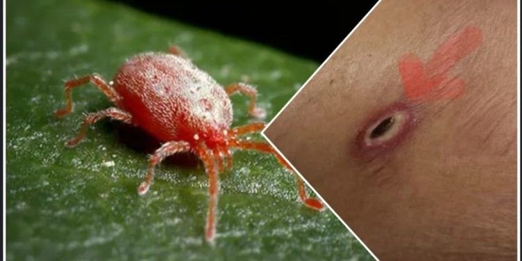 স্ক্রাব টাইফাস : একটি প্রাণঘাতী সংক্রমণ ; এই সংক্রমণের উপসর্গ,প্রতিকার ও সতর্কতা অবলম্বনের বিষয়ে বিশেষজ্ঞরা কি পরামর্শ দিচ্ছেন জানুন  