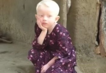 বিরল রোগে আক্রান্ত হয়ে মেয়ের শরীরের চামড়া সাধা হয়ে গেছে, স্ত্রীকে তালাক দিয়ে দুবাই পালালো স্বামী 