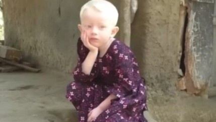 বিরল রোগে আক্রান্ত হয়ে মেয়ের শরীরের চামড়া সাধা হয়ে গেছে, স্ত্রীকে তালাক দিয়ে দুবাই পালালো স্বামী