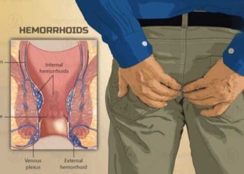 ক্ষরকর্ম : অর্শ নির্মুল করতে সুশ্রুত সংহিতায় বর্ণিত অব্যর্থ চিকিৎসা পদ্ধতি  