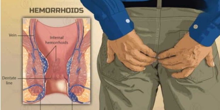 ক্ষরকর্ম : অর্শ নির্মুল করতে সুশ্রুত সংহিতায় বর্ণিত অব্যর্থ চিকিৎসা পদ্ধতি  