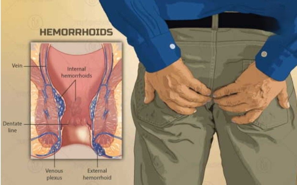 ক্ষরকর্ম : অর্শ নির্মুল করতে সুশ্রুত সংহিতায় বর্ণিত অব্যর্থ চিকিৎসা পদ্ধতি