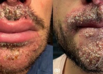 সমকামী পুরুষদের মধ্যে দ্রুত ছড়াচ্ছে যৌনবাহিত মারাত্মক সংক্রামক ছত্রাকজনিত রোগ ; জানুন এর উপসর্গ কি কি 