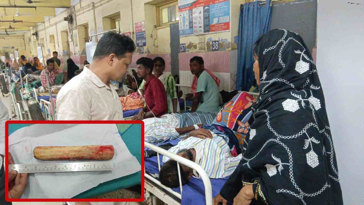 সালারের আখতার আলির মলদ্বার থেকে ৮ ইঞ্চি মোটাসোটা কাঠের বাঁট বের করে প্রাণ বাঁচালেন কাটোয়া হাসপাতালের শল্য চিকিৎসক ডঃ সুব্রত হালদার 